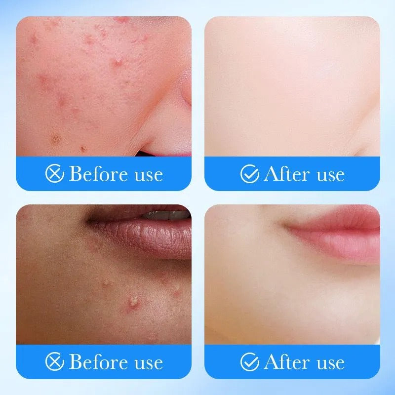 Sadoer Salicylic Acid Acne patch repair acne skin & promote healing Pimple Patch Invisible Pimple Patches for Clearer Skin